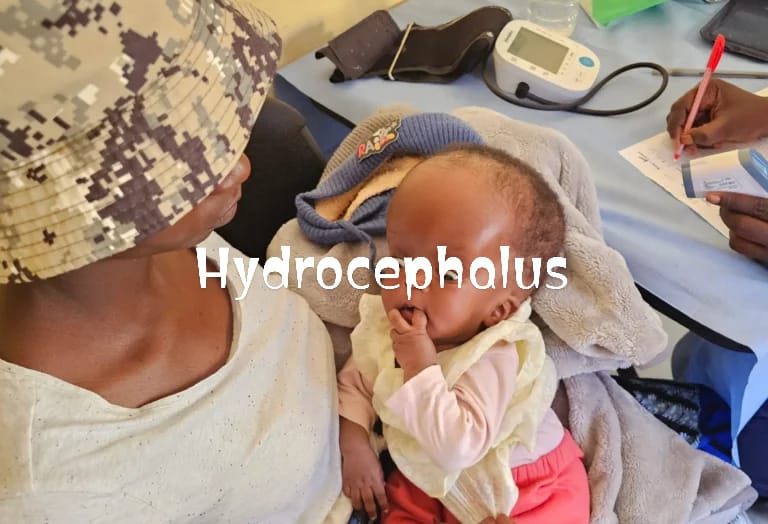 EXPERT URGES EARLY TREATMENT OF HYDROCEPHALUS TO PREVENT&nbsp;DISABILITY