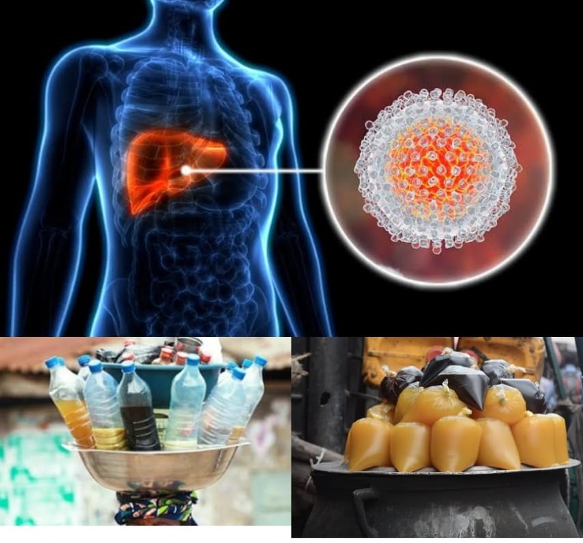 LIVER DISEASE: THE DANGERS OF DELAYED DIAGNOSIS AND HERBAL&nbsp;REMEDIES