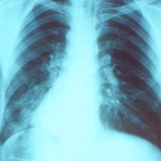 MISTAKING PNEUMONIA FOR COMMON COLD CAN DELAY TREATMENT, PHARMACIST&nbsp;WARNS